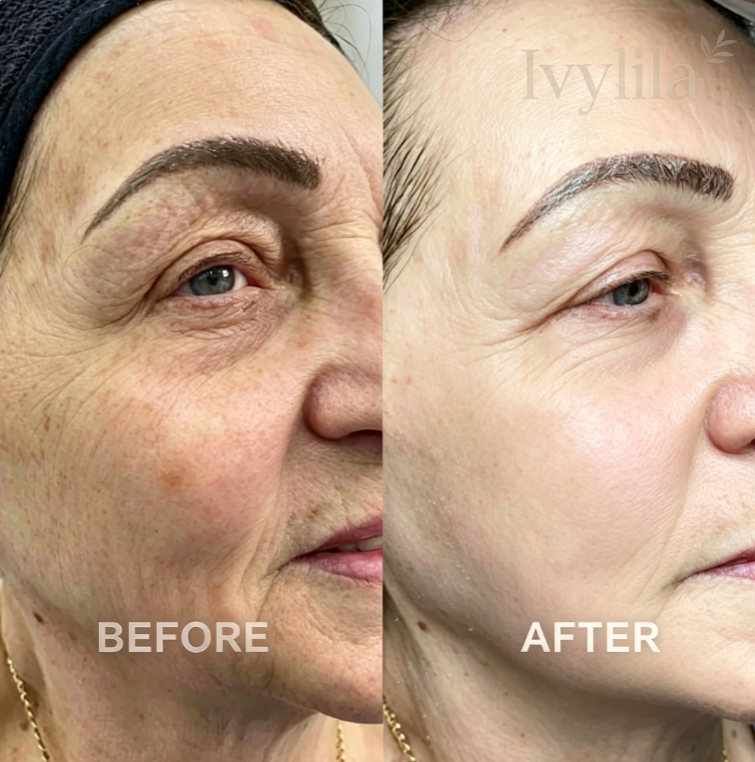 The “Face Lift In A Bottle” Everyone’s Talking About